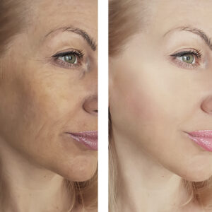 girl wrinkles before and after procedures